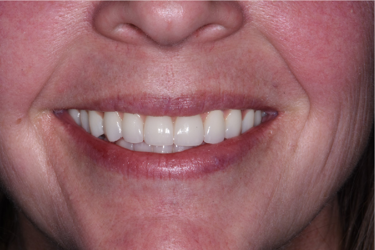 Close up of dental patient mouth before and after procedure