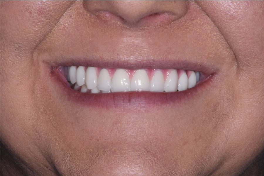 Close up of dental patient mouth before and after procedure