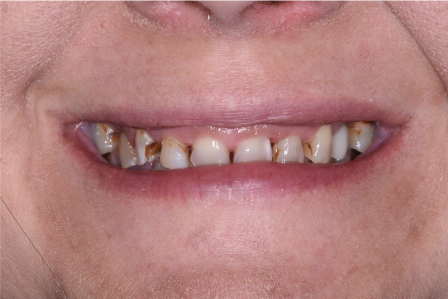 Close up of dental patient mouth before and after procedure