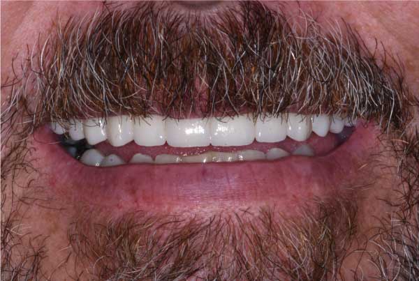 Close up of dental patient mouth before and after procedure