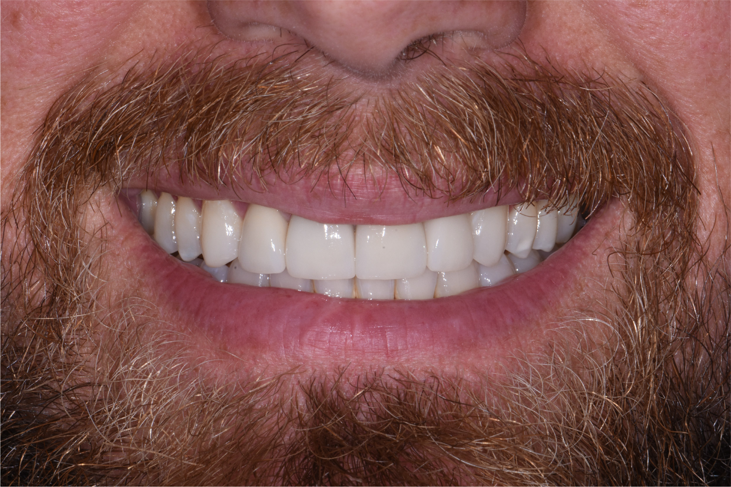 Close up of dental patient mouth before and after procedure