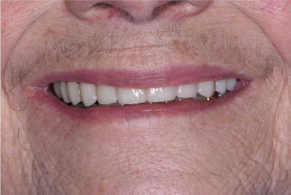 Close up of dental patient mouth before and after procedure