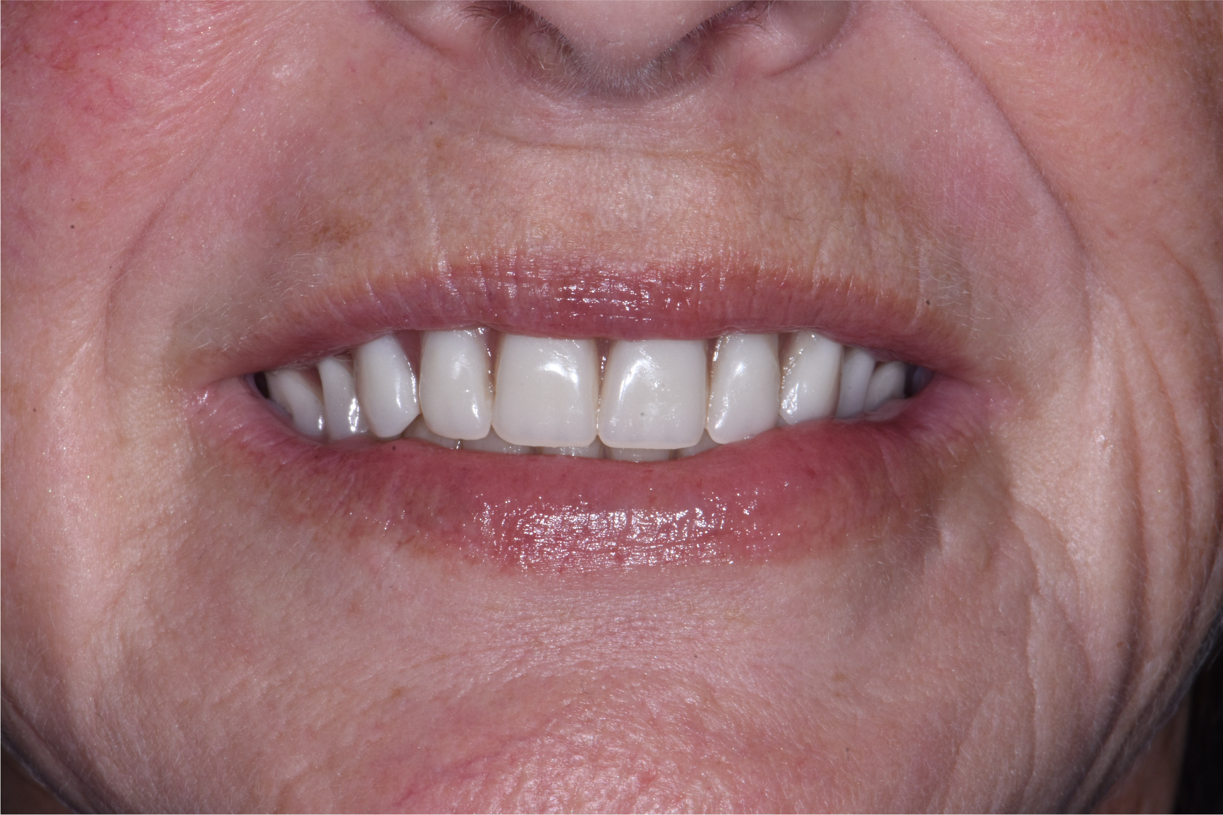 Close up of dental patient mouth before and after procedure