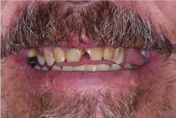 Close up of dental patient mouth before and after procedure