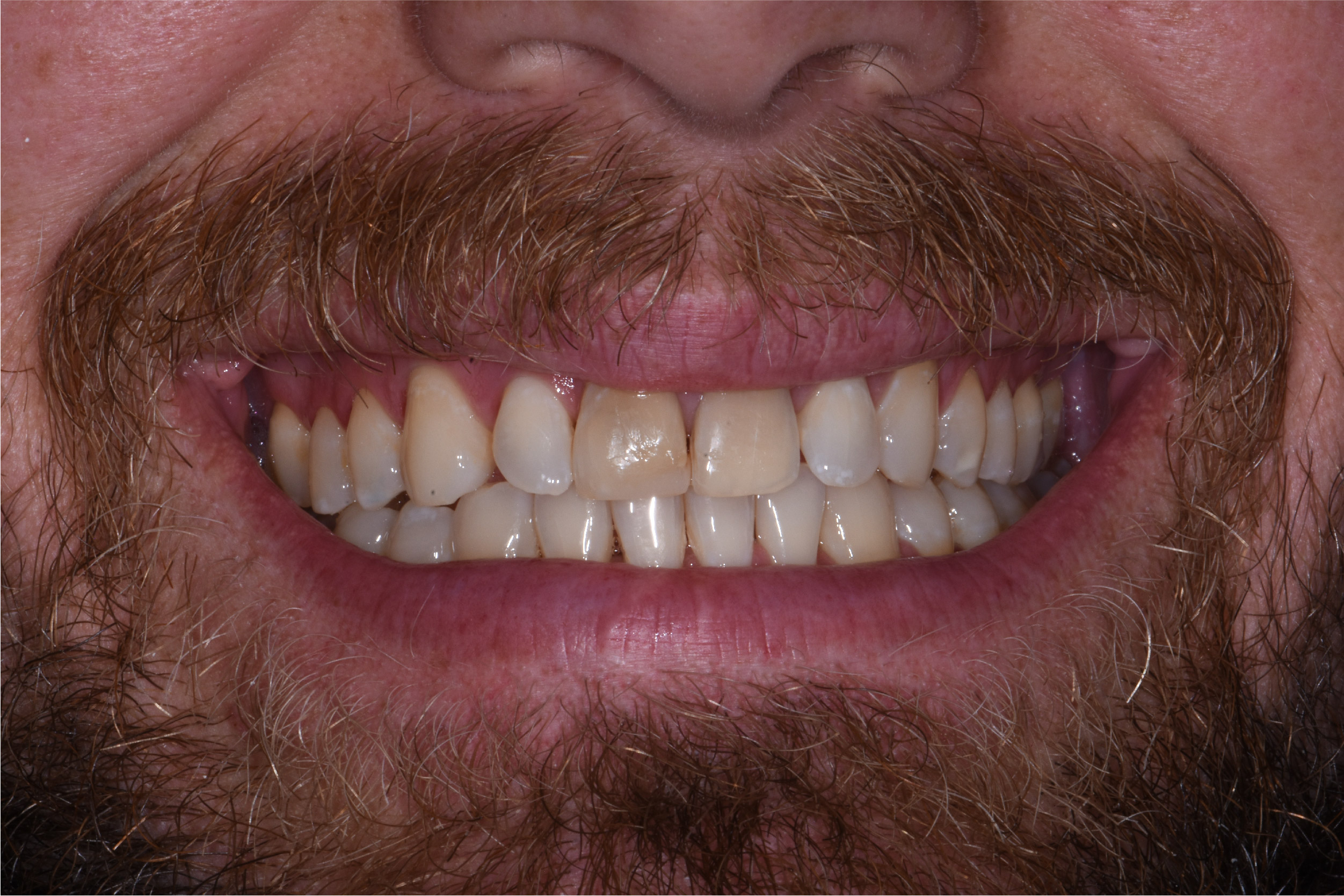 Close up of dental patient mouth before and after procedure