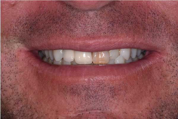 Close up of dental patient mouth before and after procedure