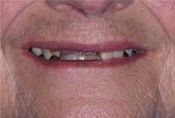 Close up of dental patient mouth before and after procedure
