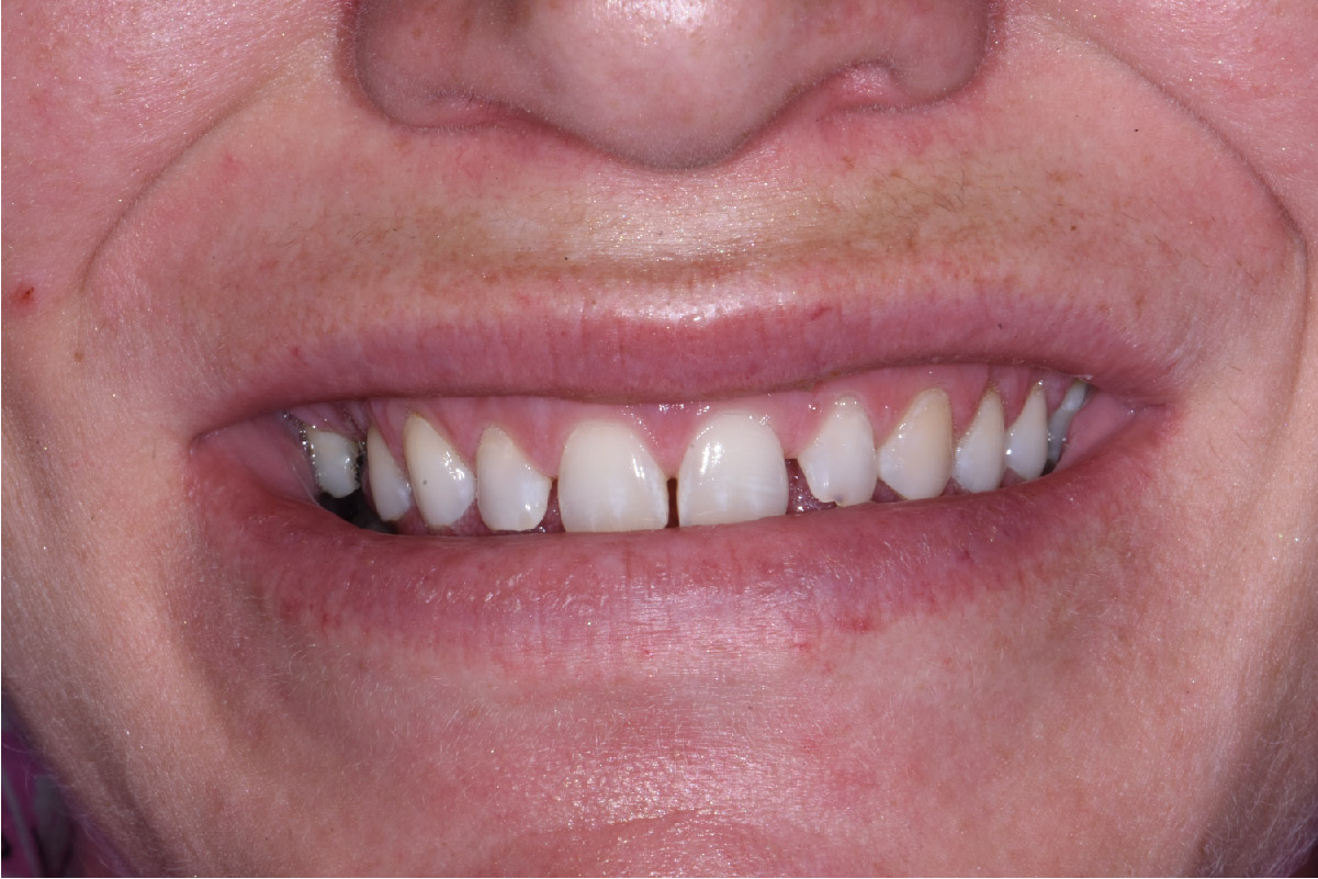 Close up of dental patient mouth before and after procedure