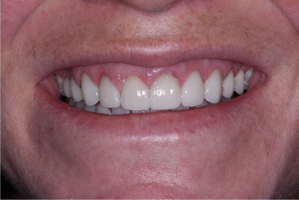Close up of dental patient mouth before and after procedure