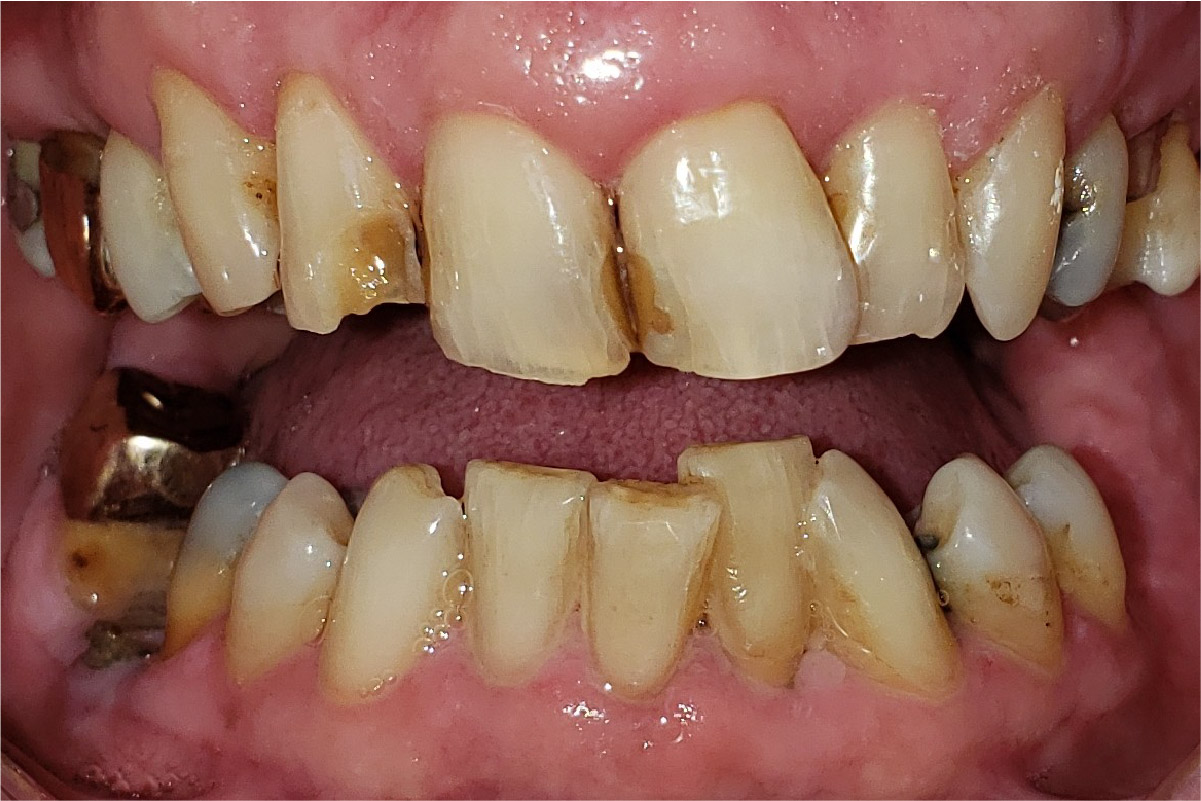 Close up of dental patient mouth before and after procedure
