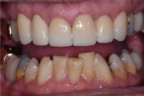 Close up of dental patient mouth before and after procedure