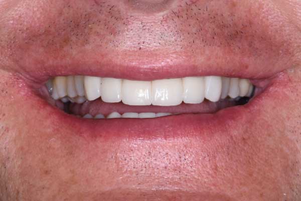 Close up of dental patient mouth before and after procedure