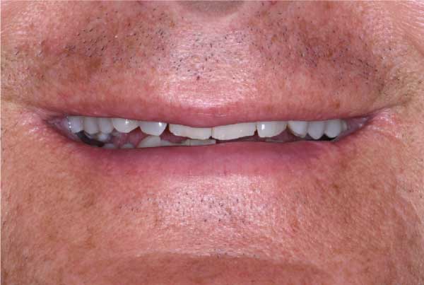 Close up of dental patient mouth before and after procedure