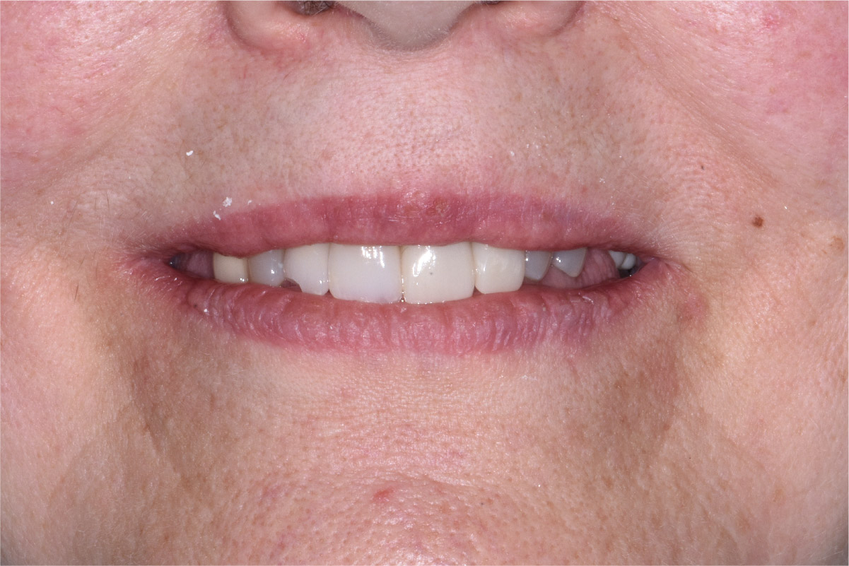 Close up of dental patient mouth before and after procedure