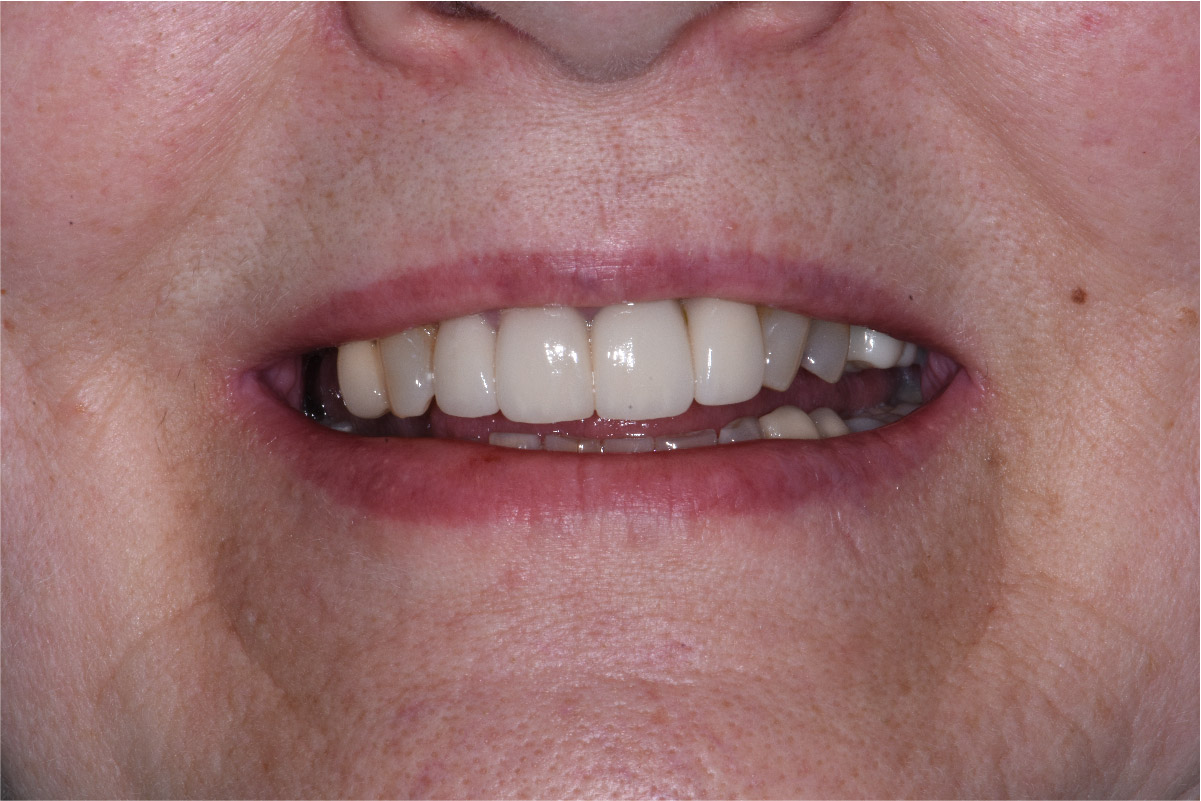 Close up of dental patient mouth before and after procedure