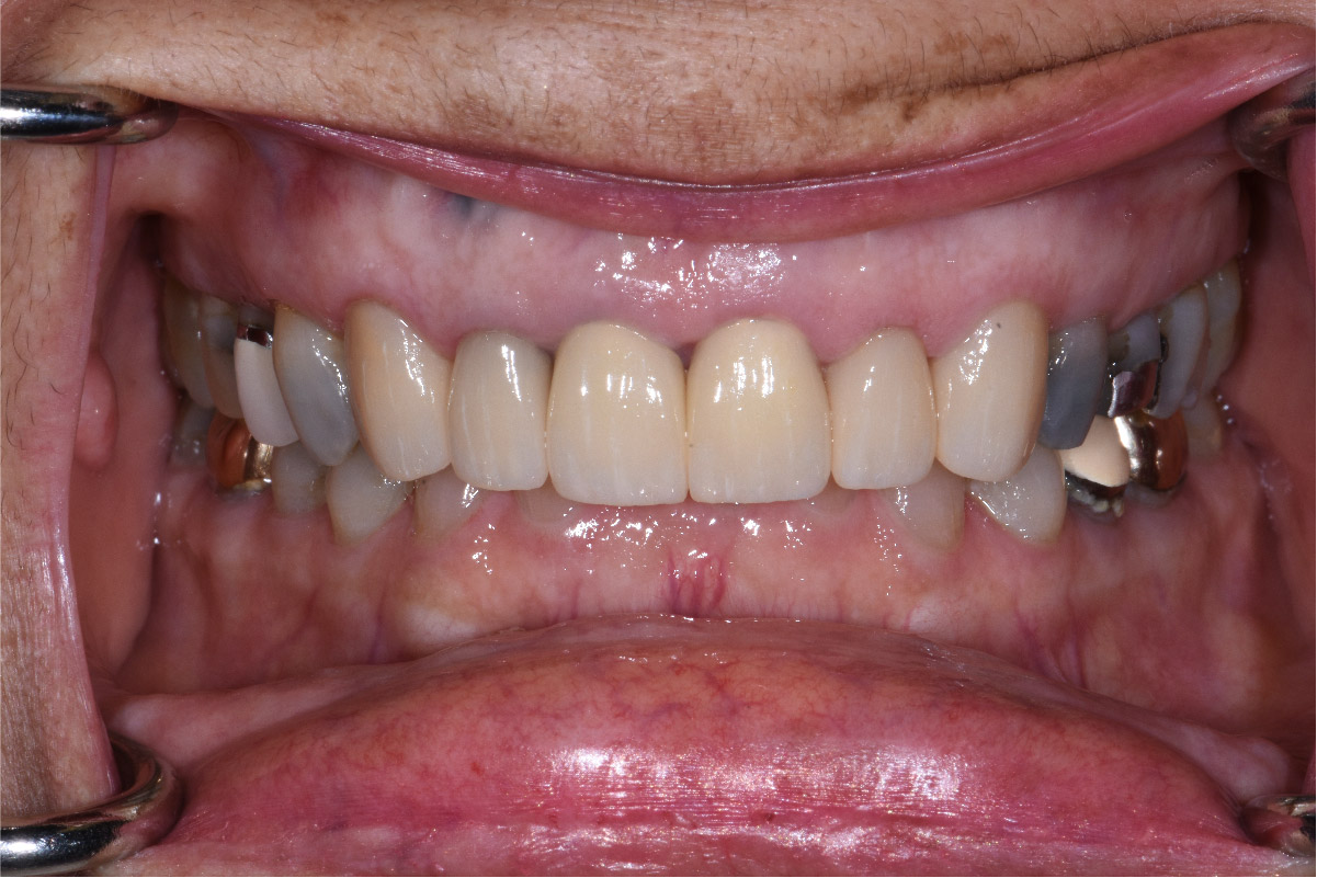 Close up of dental patient mouth before and after procedure