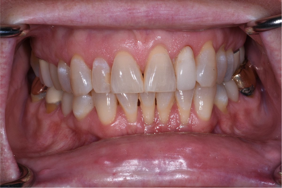 Close up of dental patient mouth before and after procedure