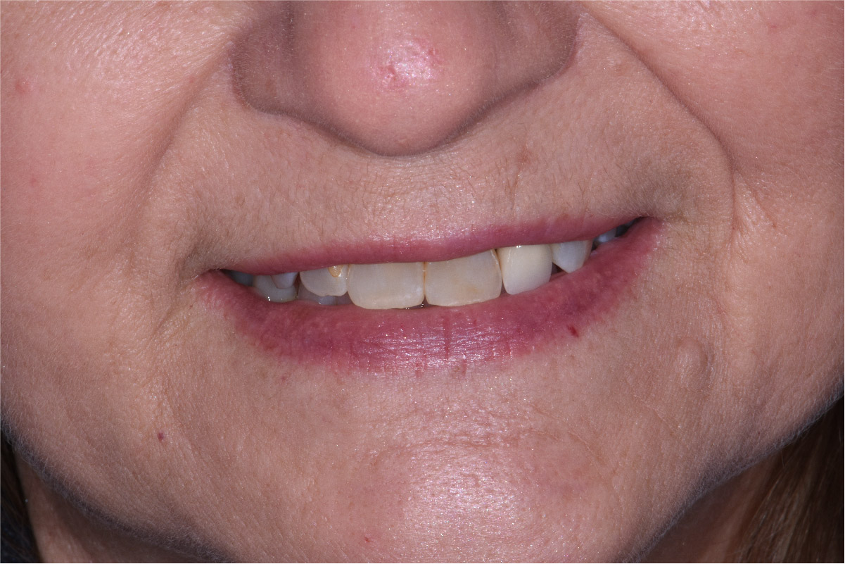 Close up of dental patient mouth before and after procedure