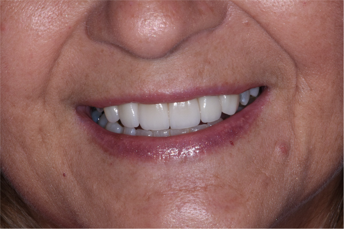 Close up of dental patient mouth before and after procedure