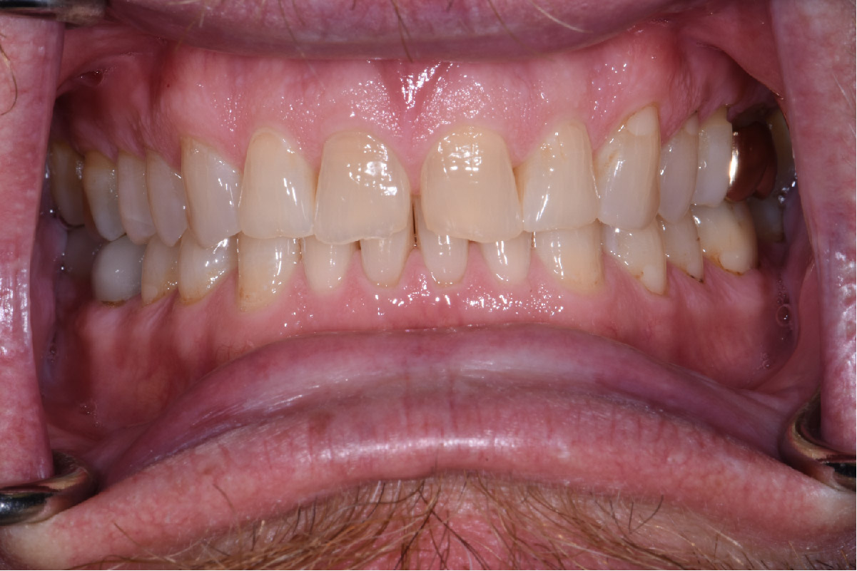Close up of dental patient mouth before and after procedure
