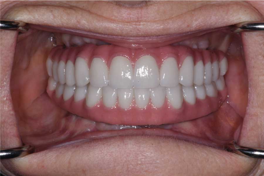 Close up of dental patient mouth before and after procedure