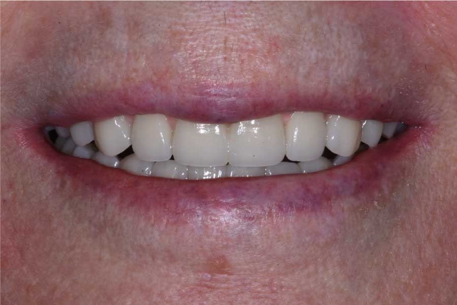 Close up of dental patient mouth before and after procedure