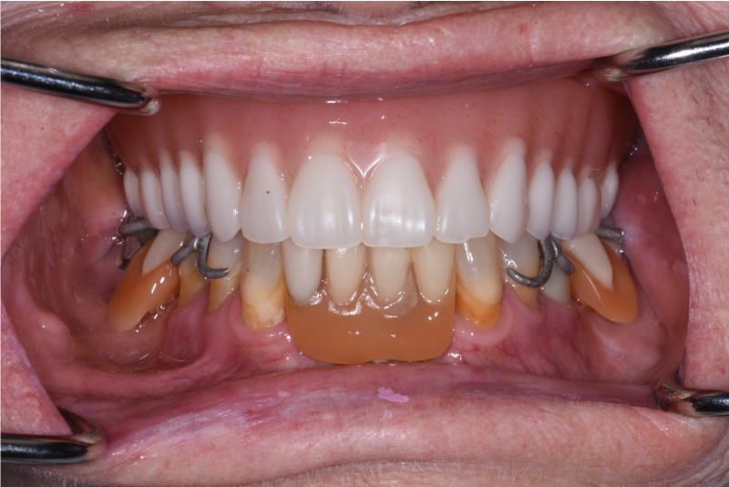Close up of dental patient mouth before and after procedure