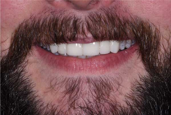 Close up of dental patient mouth before and after procedure