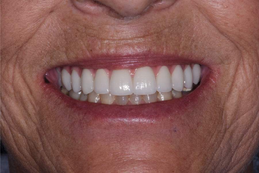Close up of dental patient mouth before and after procedure