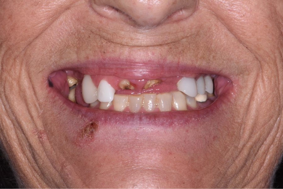 Close up of dental patient mouth before and after procedure