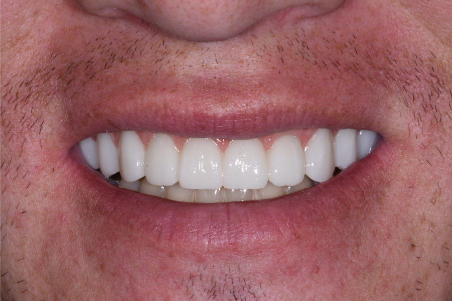 Close up of dental patient mouth before and after procedure