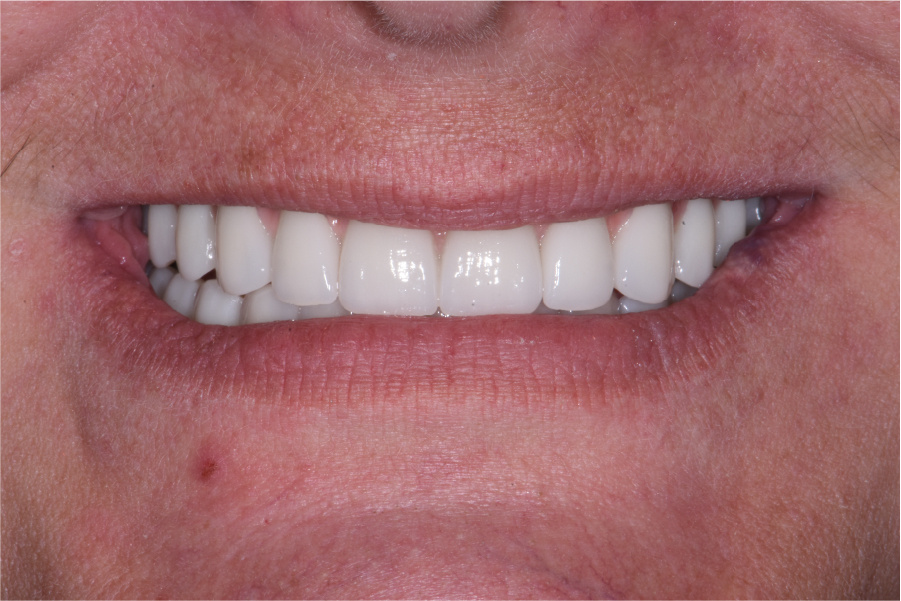 Close up of dental patient mouth before and after procedure