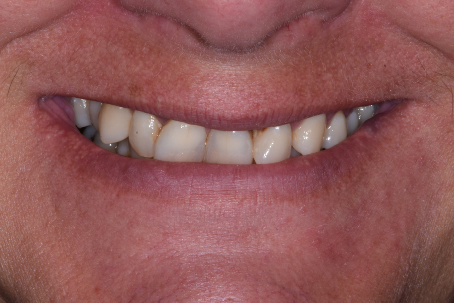Close up of dental patient mouth before and after procedure