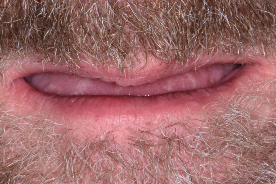 Close up of dental patient mouth before and after procedure