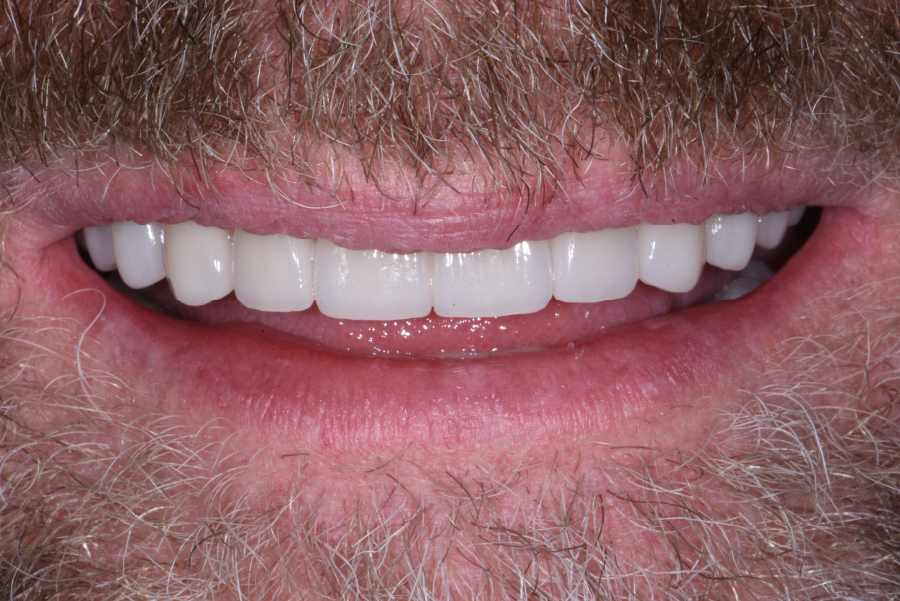 Close up of dental patient mouth before and after procedure