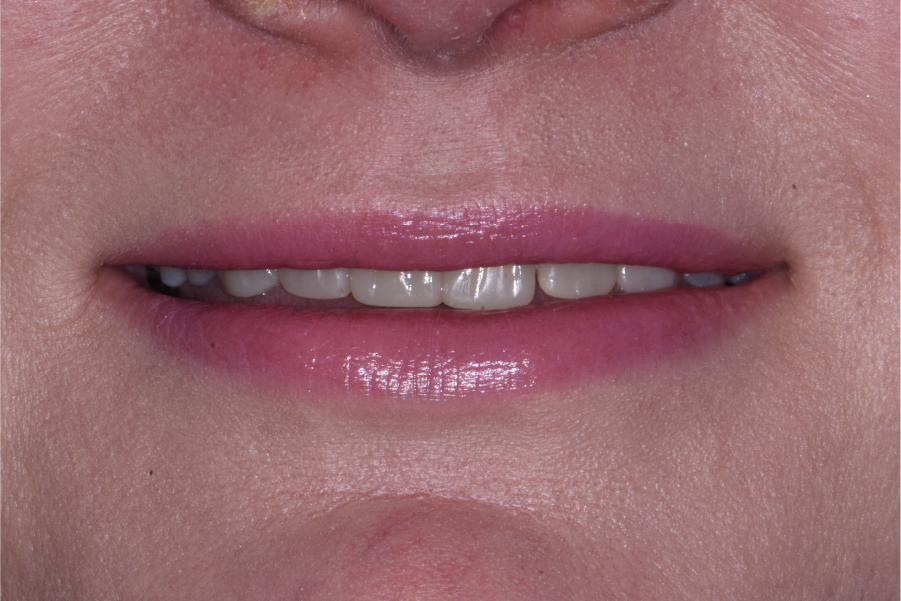 Close up of dental patient mouth before and after procedure