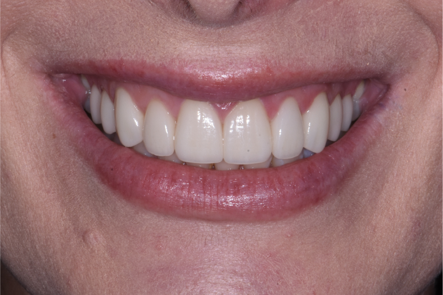 Close up of dental patient mouth before and after procedure