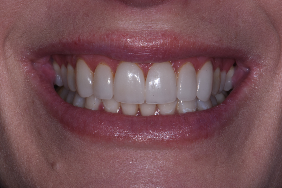 Close up of dental patient mouth before and after procedure