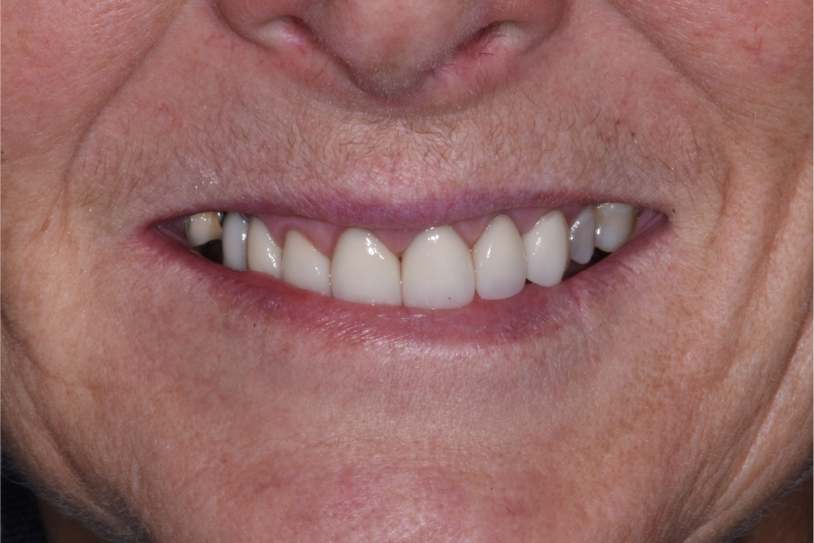 after dental procedure patient mouth