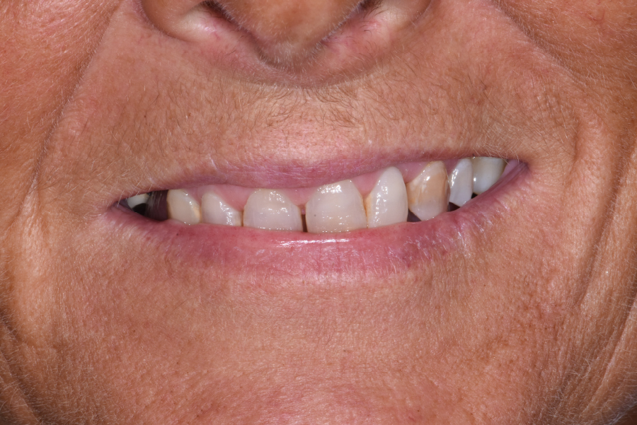 Close up of dental patient mouth before and after procedure