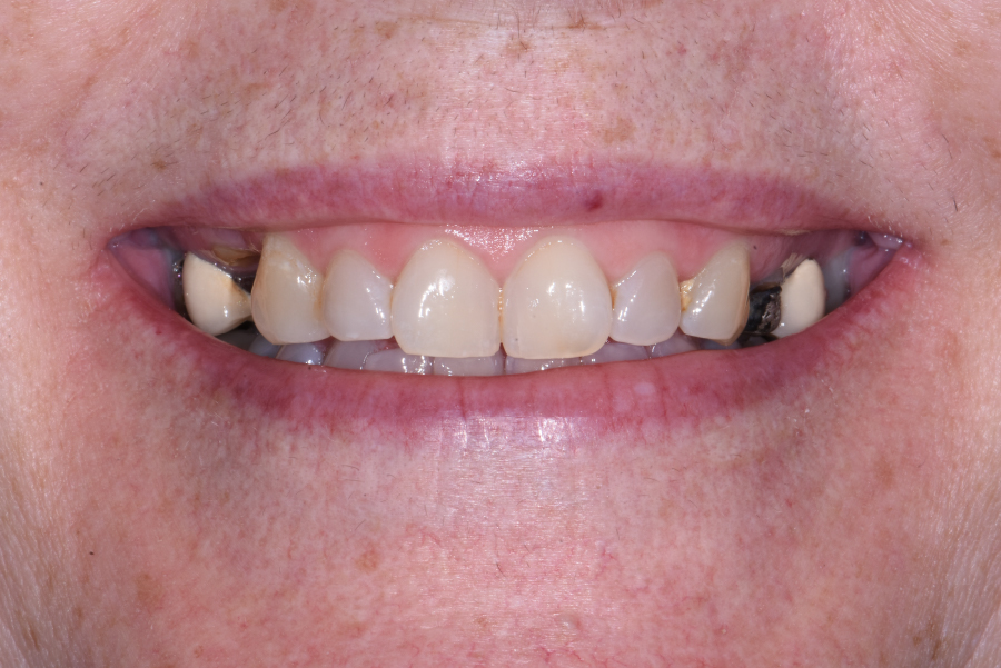 Close up of dental patient mouth before and after procedure