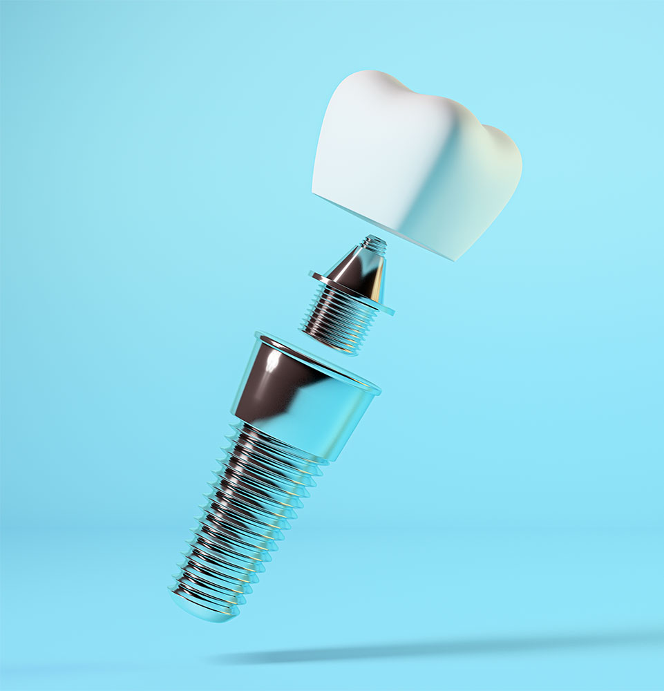 dental implant