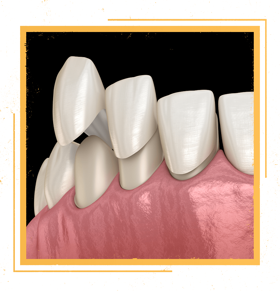 veneers