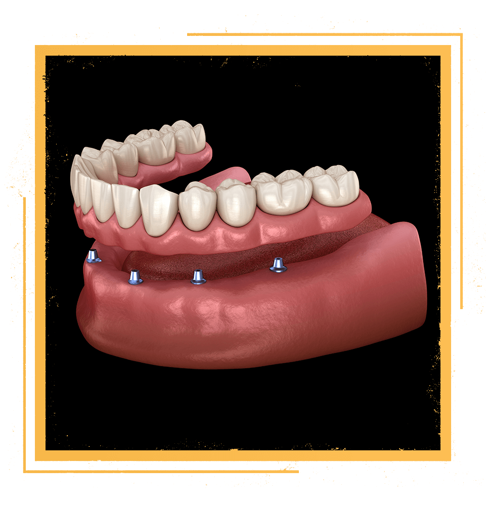 implant supported dentures