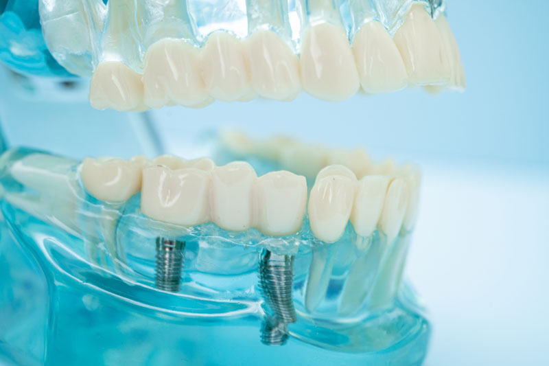 full mouth dental implant model