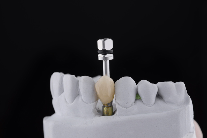 Single teeth implant restoration on dental model with black background.