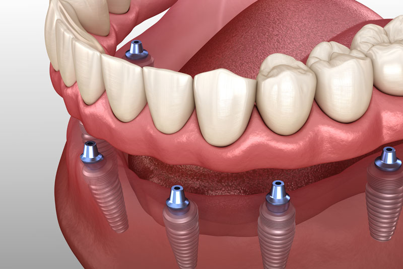 implant-supported-dentures-graphic