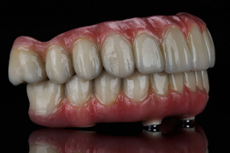 Full arch dental implant prosthesis with lifelike ceramic teeth and pink acrylic gums, designed for complete mouth restoration, shown on black reflective surface.