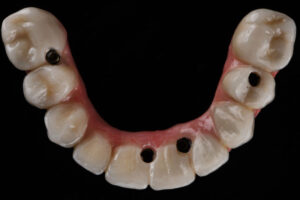 Close-up of a lower dental implant prosthesis with multiple abutment holes, showing a realistic gum-colored base and natural-looking ceramic teeth on a black background.