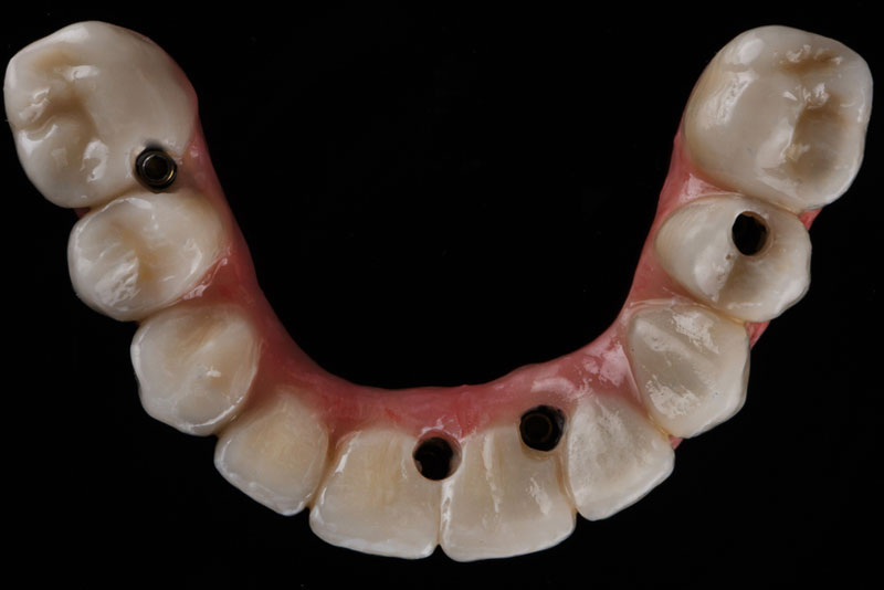 Close-up of a lower dental implant prosthesis with multiple abutment holes, showing a realistic gum-colored base and natural-looking ceramic teeth on a black background.